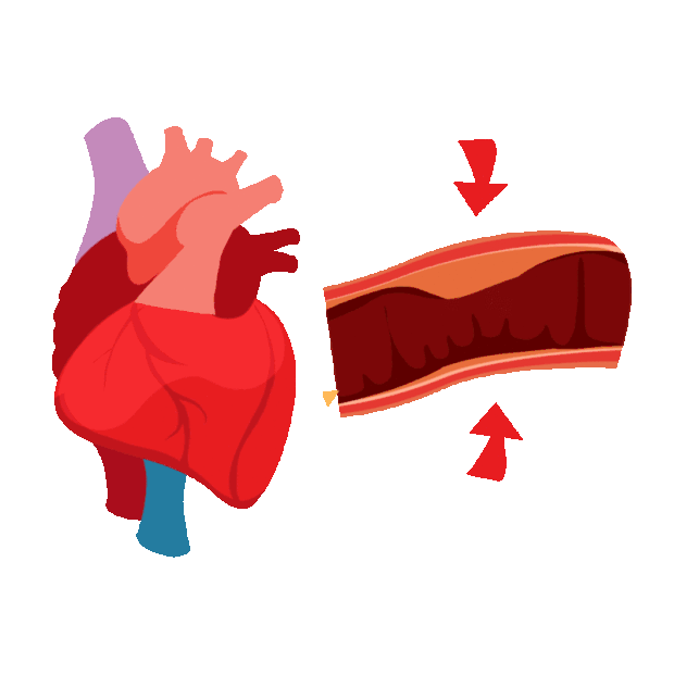 医疗心脏血管心血管疾病血管堵塞人体器官血栓红色gif图素材